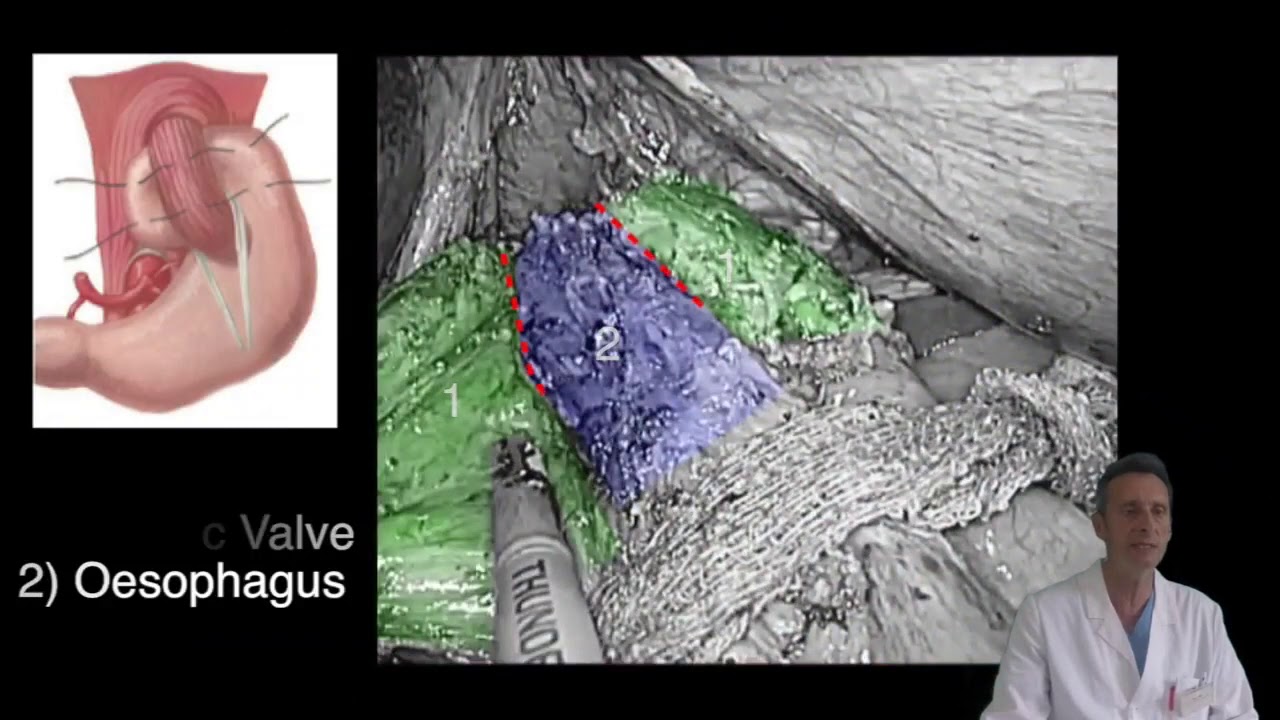 Laparoscopic Refundoplication after Nissen Fundoplication Failure, Step